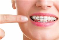 Niềng răng hô hàm trên giá bao nhiêu?