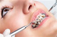 Niềng răng không mắc cài Invisalign giá bao nhiêu?