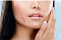 Địa chỉ trị sẹo lồi an toàn hiệu quả