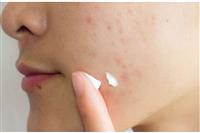 Địa chỉ trị sẹo lõm cho sinh viên giá tốt