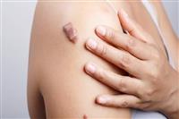 Địa chỉ spa lăn kim trị sẹo uy tín tại Hà Nội