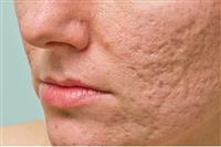 Liệu trình trị sẹo rỗ tại spa uy tín Hà Nội