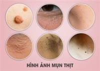 10 cách điều trị mụn thịt an toàn hiệu quả