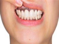 Hậu quả của việc Bọc răng sứ