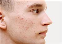 Điều cần biết về mụn viêm và cách điều trị