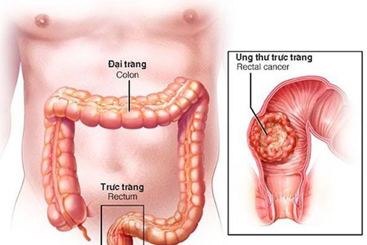 Trieu chung ung thu dai trang giai doan cuoi