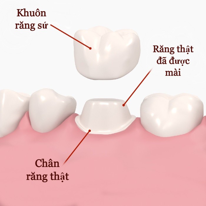 Boc su rang cua gia bao nhieu
