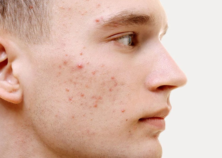 Điều cần biết về mụn viêm và cách điều trị