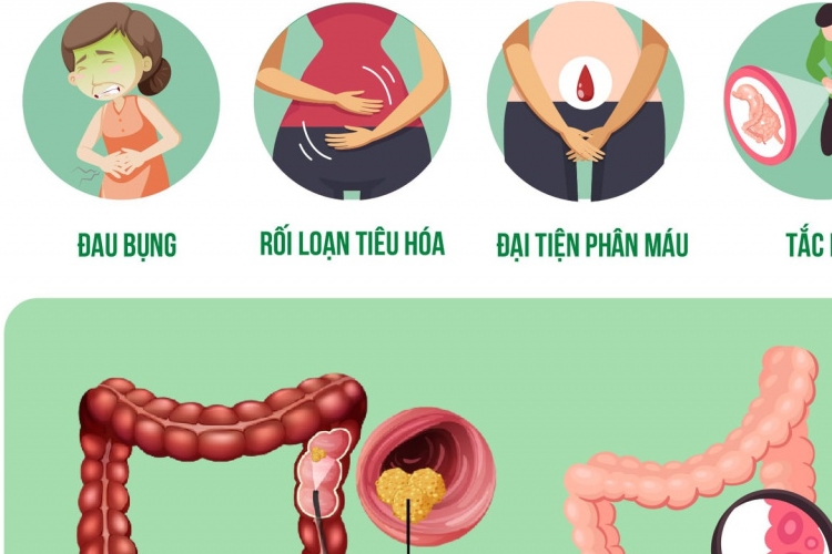 Trieu chung ung thu dai trang giai doan cuoi