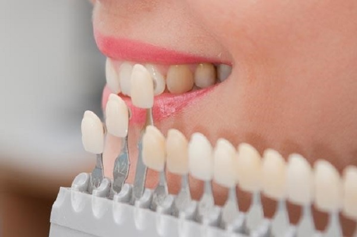 Boc su rang cua gia bao nhieu